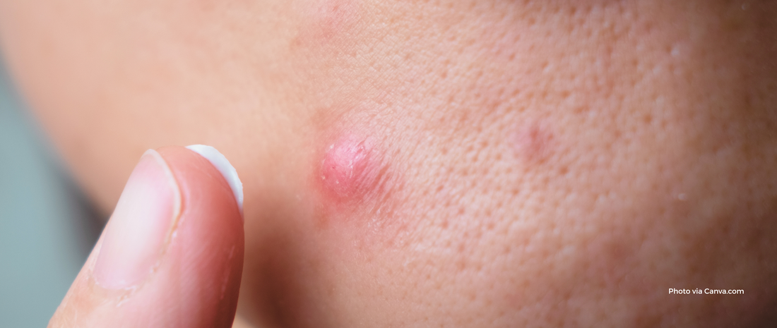 How to Shrink Cystic Pimples Without Scarring: SmartMed’s Guide