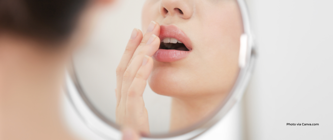 Cold Sores vs Canker Sores