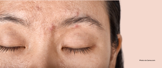 Tackling Adult Acne