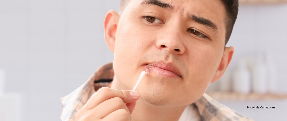 Stages of a Cold Sore