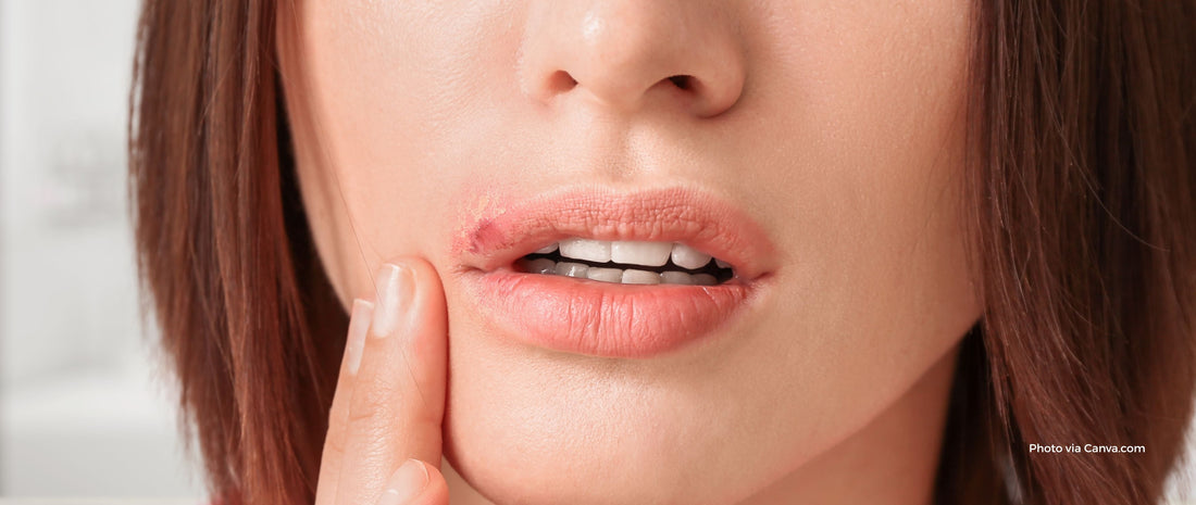How to Get Rid of Cold Sores Fast: The Complete Guide to Cold Sore Patches
