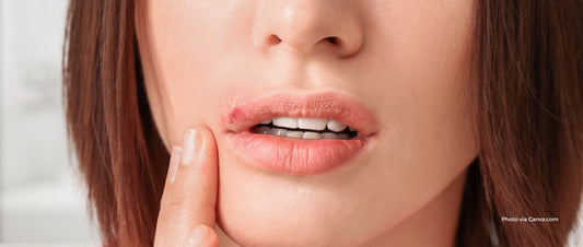 How to Get Rid of Cold Sores Fast: The Complete Guide to Cold Sore Patches