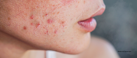 December Skincare & Acne Health: Winter Tips for Clear, Calm Skin