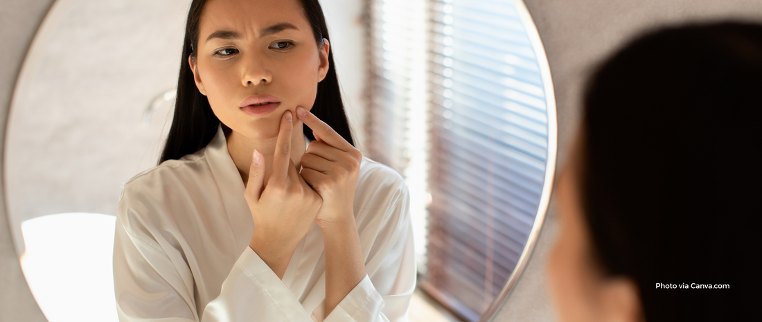 What to do After Popping a Pimple