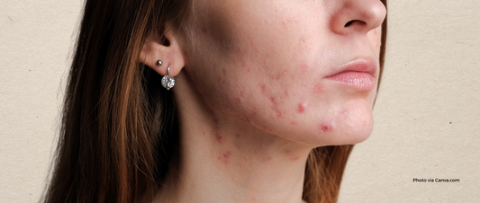 Common Causes of Acne in Adults