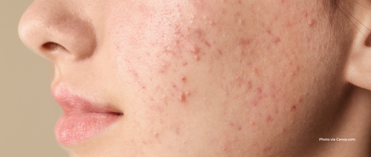 Struggling With Acne? Here's Your Ultimate Skincare Guide