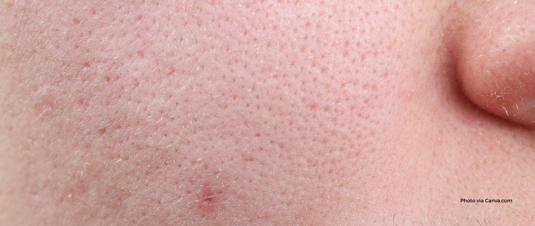 Dry or Dehydrated Skin