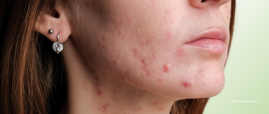 Why Do Pimples Keep Coming Back in the Same Spot? | Recurring Acne Explained