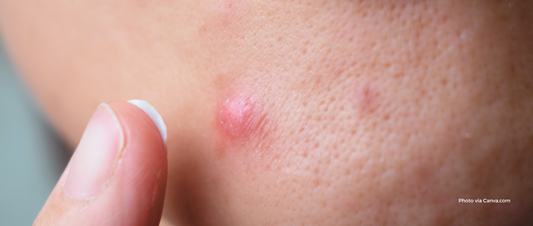 How to Shrink Cystic Pimples Without Scarring: SmartMed’s Guide